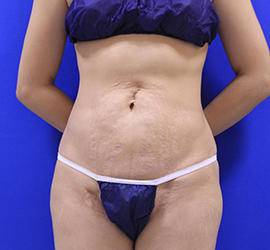 30代女性の脂肪吸引 After 症例写真