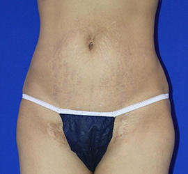 30代女性の脂肪吸引 After 症例写真