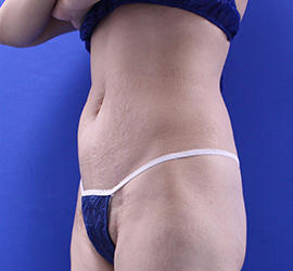 30代女性の脂肪吸引 Before 症例写真