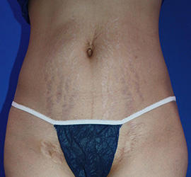 30代女性の脂肪吸引 Before 症例写真