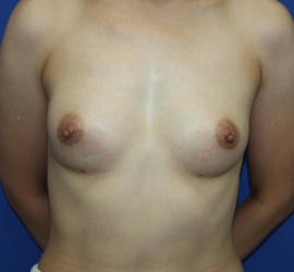 40代女性のピュアグラフト豊胸 After 症例写真