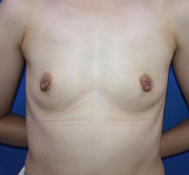 40代女性のピュアグラフト豊胸 Before 症例写真