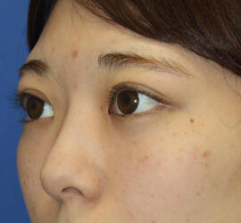 20代女性の3Dリポアイリフト  After 症例写真