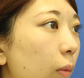 20代女性の3Dリポアイリフト  After 症例写真