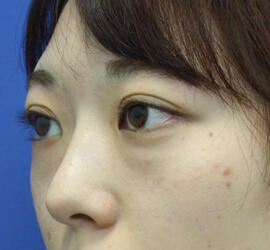 20代女性の3Dリポアイリフト  Before 症例写真