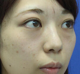 20代女性の3Dリポアイリフト  Before 症例写真