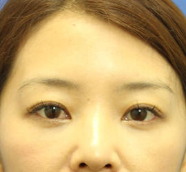 40代女性の目の下のクマ治療 After 症例写真