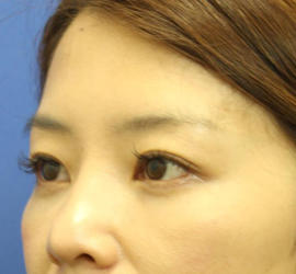 40代女性の3Dリポアイリフト  After 症例写真