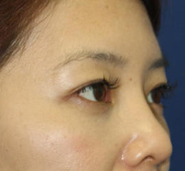 40代女性の3Dリポアイリフト  After 症例写真