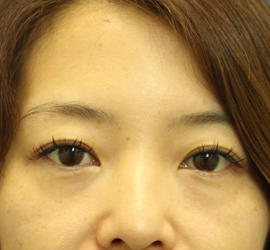 40代女性の目の下のクマ治療 Before 症例写真