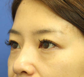 40代女性の3Dリポアイリフト  Before 症例写真