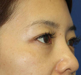 40代女性の3Dリポアイリフト  Before 症例写真