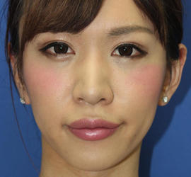 20代女性のヒアルロン酸注射（唇） After 症例写真