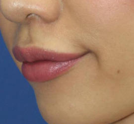 20代女性のヒアルロン酸注射（唇） After 症例写真