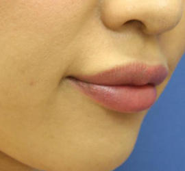 20代女性のヒアルロン酸注射（唇） After 症例写真