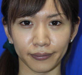 20代女性のヒアルロン酸注射（唇） Before 症例写真