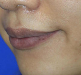 20代女性のヒアルロン酸注射（唇） Before 症例写真