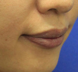 20代女性のヒアルロン酸注射（唇） Before 症例写真