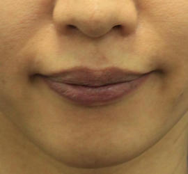 20代女性のボトックス （口角） Before 症例写真