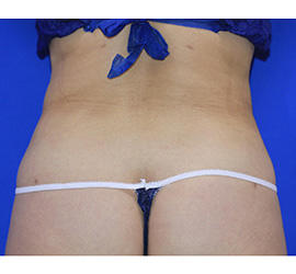 40代女性の脂肪吸引 After 症例写真