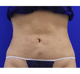 40代女性の脂肪吸引 After 症例写真