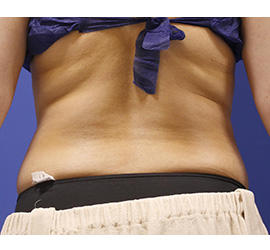 40代女性の脂肪吸引 Before 症例写真