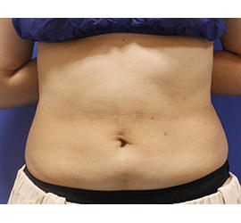 40代女性の脂肪吸引 Before 症例写真