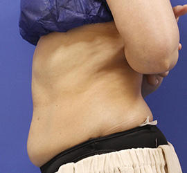 40代女性の脂肪吸引 Before 症例写真