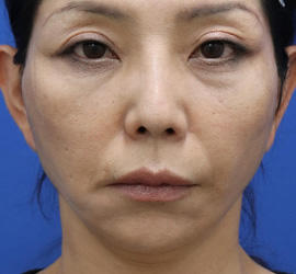 50代女性のチークリフト・フェイスリフト After 症例写真