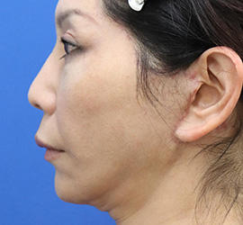 50代女性のチークリフト・フェイスリフト After 症例写真