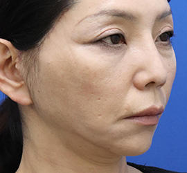 50代女性のチークリフト・フェイスリフト After 症例写真