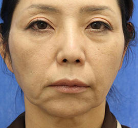 50代女性のチークリフト・フェイスリフト Before 症例写真
