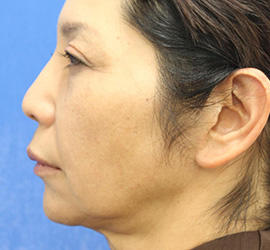 50代女性のチークリフト・フェイスリフト Before 症例写真