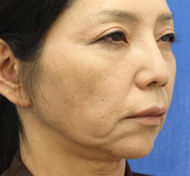 50代女性のチークリフト・フェイスリフト Before 症例写真