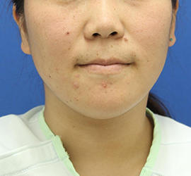 20代女性の顔の脂肪吸引 After 症例写真