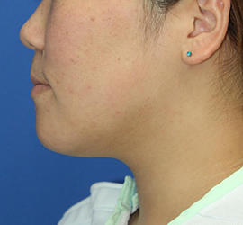 20代女性の顔の脂肪吸引  After 症例写真