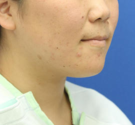 20代女性の顔の脂肪吸引  After 症例写真