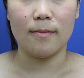 20代女性の顔の脂肪吸引 Before 症例写真