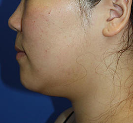 20代女性の顔の脂肪吸引  Before 症例写真