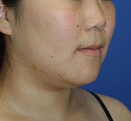 20代女性の顔の脂肪吸引  Before 症例写真