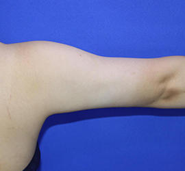 20代女性の脂肪吸引 After 症例写真