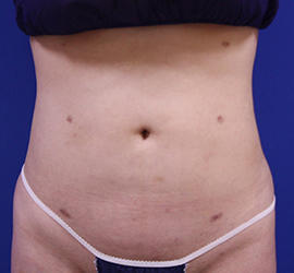 20代女性の脂肪吸引 After 症例写真