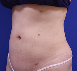 20代女性の脂肪吸引 After 症例写真