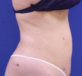 20代女性の脂肪吸引 After 症例写真