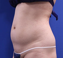 20代女性の脂肪吸引 Before 症例写真