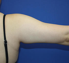 20代女性の脂肪吸引 Before 症例写真