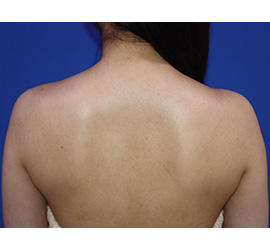 20代女性のボトックス（美肩・肩こり解消） After 症例写真