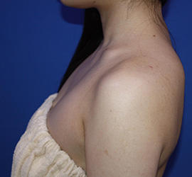 20代女性のボトックス（美肩・肩こり解消） After 症例写真