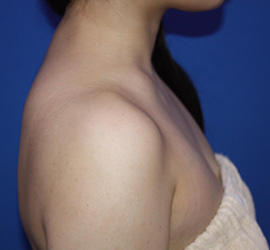 20代女性のボトックス（美肩・肩こり解消） After 症例写真