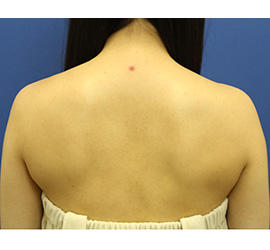 20代女性のボトックス（美肩・肩こり解消） Before 症例写真